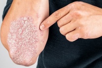 Chìa khóa giúp người bệnh vảy nến ổn định triệu chứng lâu dài