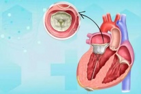 Bệnh hở van tim và tim to có chữa khỏi được không?