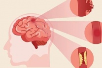 Dấu hiệu tai biến mạch máu não thường bị bỏ qua 
