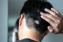 Lầm tưởng thường gặp về chứng rụng tóc từng mảng