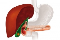 Sỏi mật 25mm dùng TPBVSK Kim Đởm Khang được không?