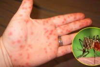 Sốt xuất huyết, tay chân miệng nặng tăng cao, Bộ Y tế cảnh báo khẩn