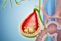 Khi nào sỏi túi mật 17mm trở thành vấn đề đáng lo ngại?