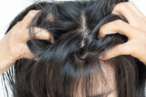 5 yếu tố âm thầm khiến vảy nến da đầu tái phát liên tục