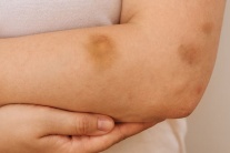 Hay bầm tím, cẩn thận thiếu vi chất