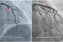 Thanh niên 29 tuổi phát hiện nhồi máu cơ tim cấp khi đi nội soi dạ dày
