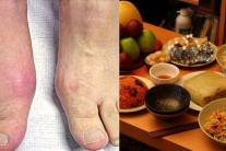 Mẹo để ngăn bệnh gout “ghé thăm” ngày Tết