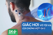 Podcast: Giác hơi vô tội vạ, coi chừng đột quỵ