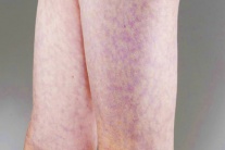 Dấu hiệu lạ trên da có thể cảnh báo vấn đề tim mạch