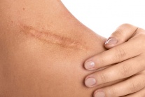 Cùng là vết thương, vì sao mặt ít sẹo hơn cơ thể?