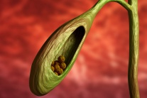 Sỏi túi mật 4,5mm dùng TPBVSK Kim Đởm Khang được không?