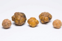 Sỏi mật 39mm nguy hiểm tới thế nào?