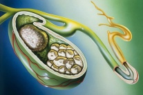 Tại sao đã mổ lấy sỏi mật 13mm vẫn tái phát sau 6 tháng?