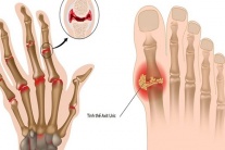 Chế độ ăn uống giúp giảm acid uric