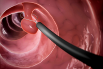 5 cách bảo vệ đại tràng, hạn chế nguy cơ ung thư từ polyp