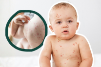 Cách giảm ngứa khi mắc thủy đậu