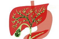 Sỏi gan 7,5mm nên mổ hay dùng cách tẩy sỏi gan 1 ngày?