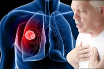 Cách kiểm soát triệu chứng khó thở do u phổi