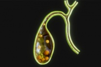 Có sỏi túi mật 21mm dùng TPBVSK Kim Đởm Khang được không?