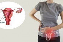 U xơ tử cung có gây hiếm muộn không?