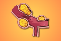 Xơ vữa động mạch: Nguyên nhân, mức độ nguy hiểm và giải pháp hỗ trợ phòng ngừa