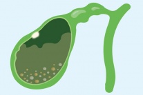 Có polyp túi mật và sỏi bùn túi mật cần cẩn trọng gì?