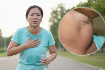 Khả năng vận động suy giảm vì bướu cổ do thiếu iod