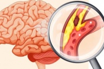 Những ai dễ bị nhồi máu não?