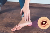 Bạn cần biết gì về biến chứng bàn chân do đái tháo đường?