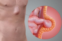 Làm thế nào để tự đánh giá nguy cơ mắc thoát vị?