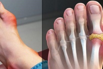 Bệnh gout cấp có chữa khỏi được không?