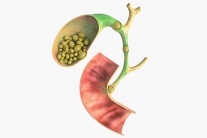 Sỏi ống mật chủ sau phẫu thuật có nguy hiểm không?