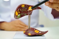 Tổng quan về sỏi đường mật trong gan: Những điều bạn cần biết