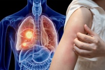 Dấu hiệu ngoài da cảnh báo u phổi