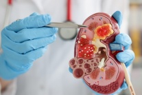 Sỏi thận có tự đào thải không?