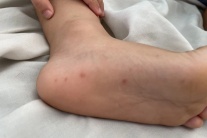 Ca bệnh tay chân miệng tăng gấp 5 lần, Bộ Y tế yêu cầu siết chặt kiểm soát