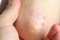 Cây sói rừng - thảo dược hỗ trợ cải thiện bệnh vảy nến hiệu quả