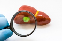 Polyp túi mật có nguy hiểm không?