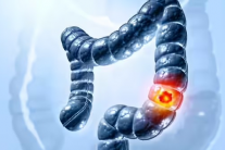 5 dấu hiệu ung thư đại tràng phổ biến dễ bị bỏ qua