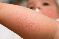 Bệnh sởi và nguy cơ suy giảm miễn dịch