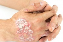 Bị vảy nến thể mảng cần lưu ý những gì?