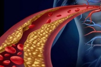Rối loạn lipid máu có chữa khỏi được không?