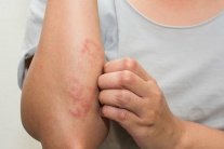Viêm mao mạch dị ứng ở trẻ em có nguy hiểm không?