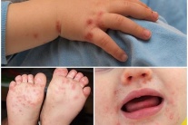 Sốt xuất huyết và tay chân miệng cùng gia tăng mạnh