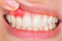 Mách bạn 5 cách cải thiện viêm lợi tại nhà