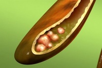 Sỏi bùn túi mật 7mm kèm đái tháo đường: Dùng TPBVSK Kim Đởm Khang được không?