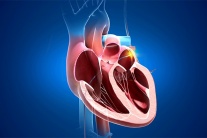 Đốt điện tim rồi vẫn tái phát, có nên tiếp tục can thiệp hay chuyển hướng khác?