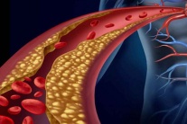 Rối loạn lipid máu: Nhận diện nguy cơ và giải pháp kiểm soát an toàn