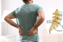 Triệu chứng cảnh báo thoát vị đĩa đệm lưng không nên bỏ qua