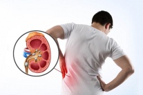 Chế độ ăn uống giúp ngăn sỏi thận tái phát